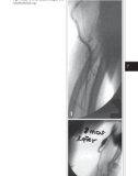 Access for Dialysis: Surgical and Radiologic Procedures - part 7