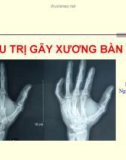 Bài giảng Điều trị gãy xương bàn tay