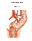 Viêm loét đại tràng (Phần 2)