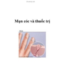 Mụn cóc và thuốc trị