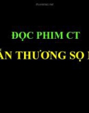 CT Chấn thương sọ não