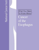 What You Need To Know About - Cancer of the Esophagus