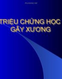 TRIỆU CHỨNG HỌC GÃY XƯƠNG