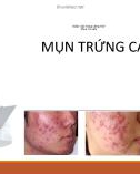 Bài giảng Mụn trứng cá - Bệnh viện Trung ương Huế