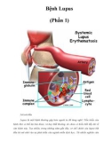 Bệnh Lupus