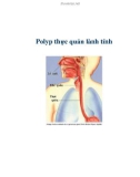 Polyp thực quản lành tính