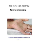 Biến chứng viêm não trong bệnh tay chân miệng