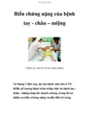 Biến chứng nặng của bệnh tay - chân – miệng