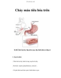 Chảy máu tiêu hóa trên