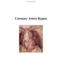 Coronary Artery Bypass