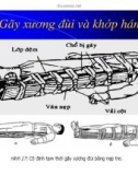 Kỹ Thuật Cố Định Tạm Thời Xương Gãy (Phần 5)