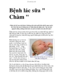 Bệnh lác sữa Chàm 