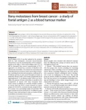 Báo cáo khoa học: Bony metastases from breast cancer - a study of foetal antigen 2 as a blood tumour markerl