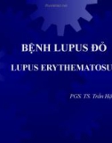 Bệnh Lupus đỏ - Lupus Erythematosus