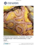 Báo cáo y học: Peritoneal dissemination of prostate cancer due to laparoscopic radical prostatectomy: a case report