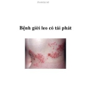 Bệnh giời leo có tái phát