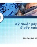 Kỹ thuật gây tê ổ gãy xương (Phần 1)