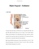 Bệnh Osgood - Schlatter