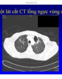 Bài giảng điều trị HIV : Các hội chứng hô hấp trong nhiễm HIV part 6