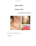 BỆNH ZÔNA (Herpes zoster)