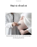 Thai và vết mổ cũ