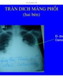 Tràn dịch màng phổi part 5