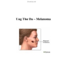 Ung Thư Da – Melanoma