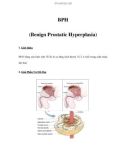 BPH (Benign Prostatic Hyperplasia)