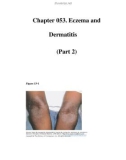 Chapter 053. Eczema and Dermatitis (Part 2)