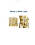 Thoát vị thành bụng