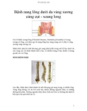 Bệnh nang lông dưới da vùng xương cùng cụt - xoang long