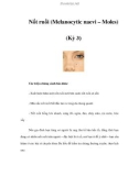 Nốt ruồi (Melanocytic naevi – Moles) (Kỳ 3)